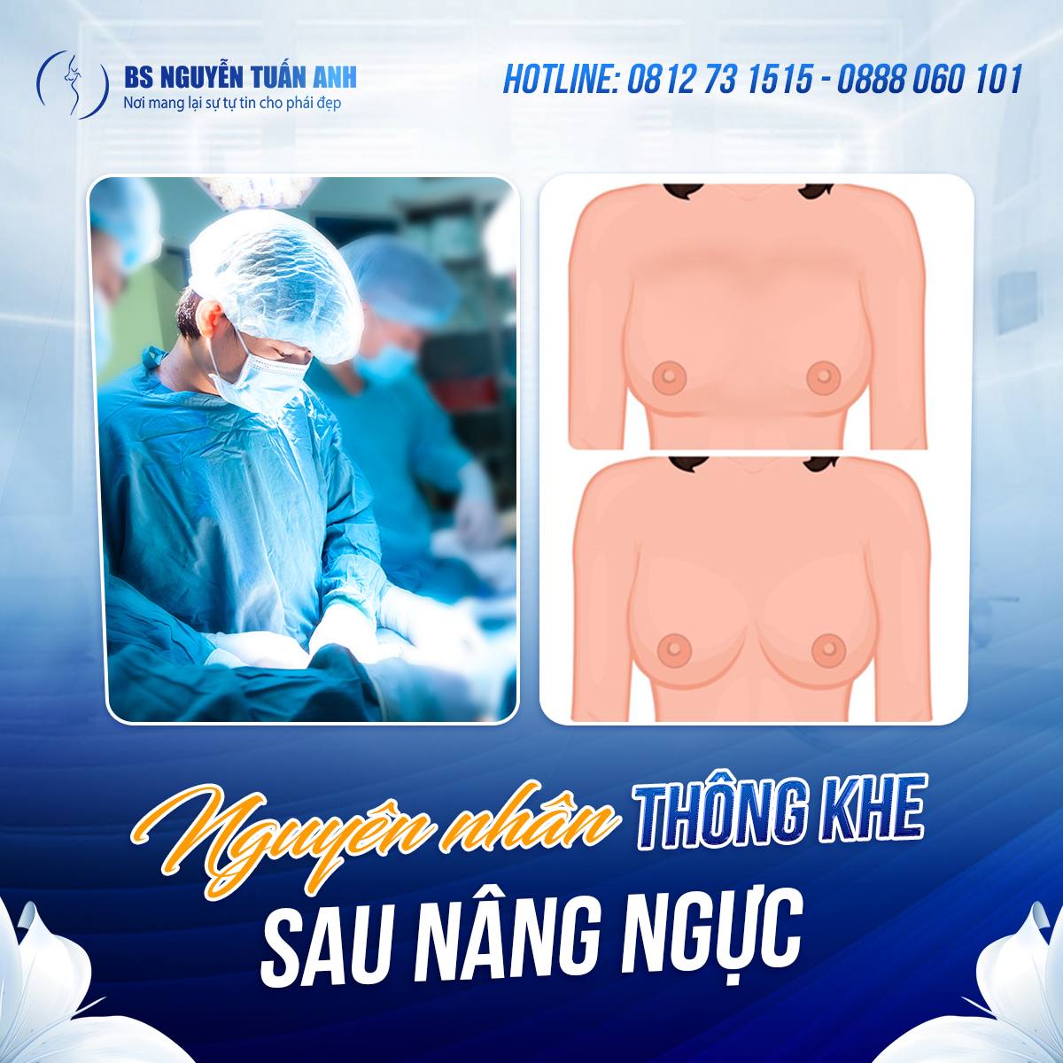 Hiểu rõ về thông khe sau nâng ngực